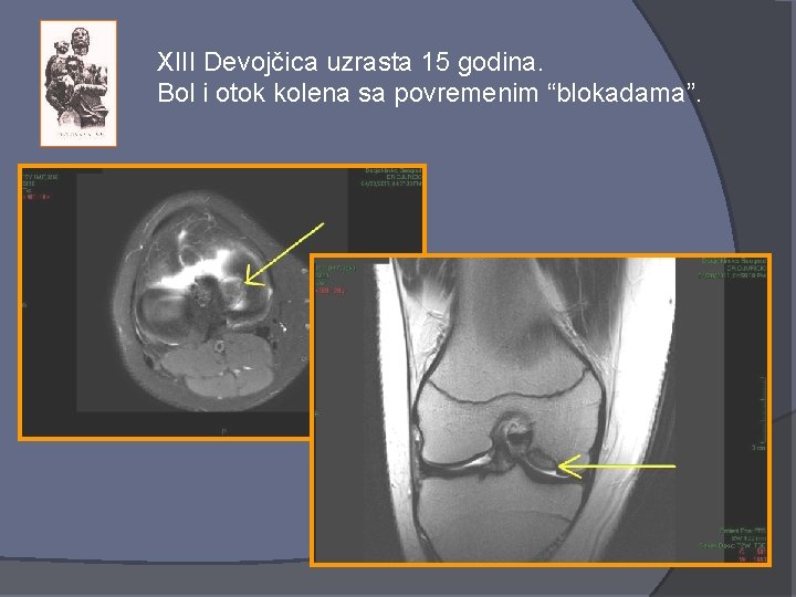 XIII Devojčica uzrasta 15 godina. Bol i otok kolena sa povremenim “blokadama”. 