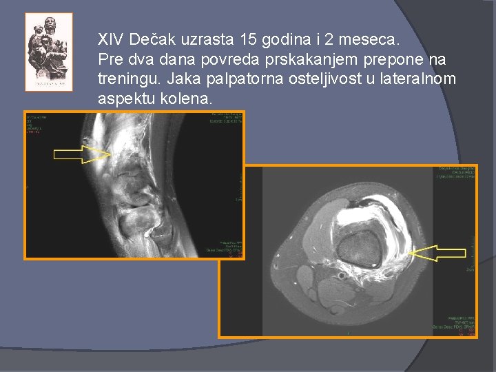 XIV Dečak uzrasta 15 godina i 2 meseca. Pre dva dana povreda prskakanjem prepone