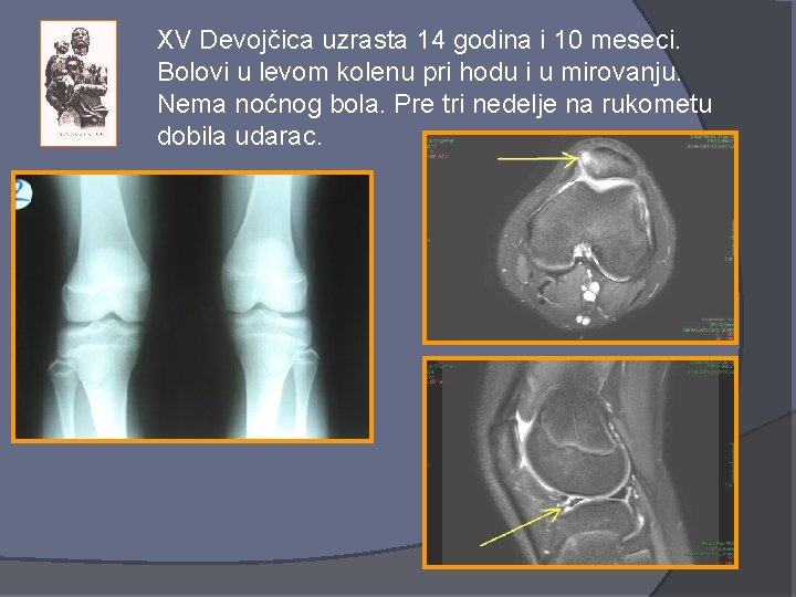 XV Devojčica uzrasta 14 godina i 10 meseci. Bolovi u levom kolenu pri hodu