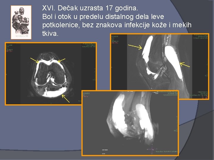 XVI. Dečak uzrasta 17 godina. Bol i otok u predelu distalnog dela leve potkolenice,