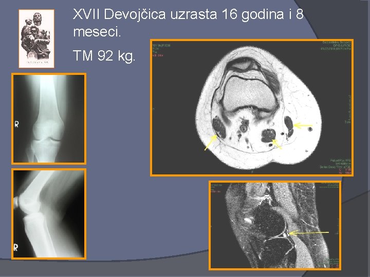 XVII Devojčica uzrasta 16 godina i 8 meseci. TM 92 kg. 