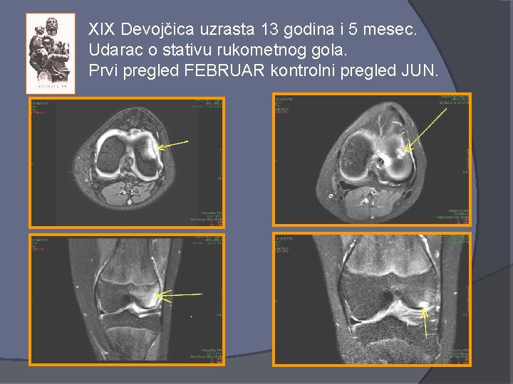 XIX Devojčica uzrasta 13 godina i 5 mesec. Udarac o stativu rukometnog gola. Prvi