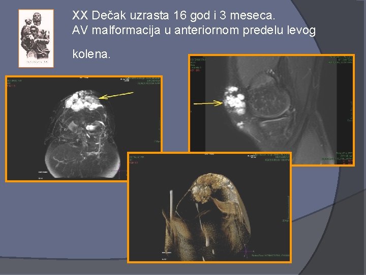 XX Dečak uzrasta 16 god i 3 meseca. AV malformacija u anteriornom predelu levog