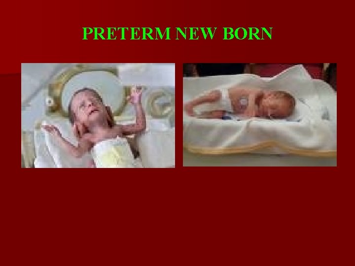 PRETERM NEW BORN 