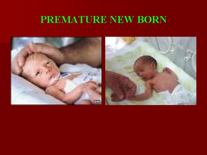 PREMATURE NEW BORN 