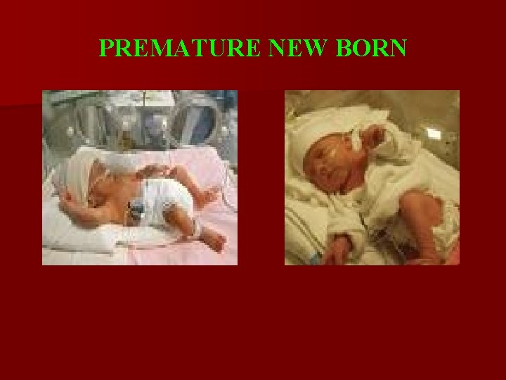 PREMATURE NEW BORN 