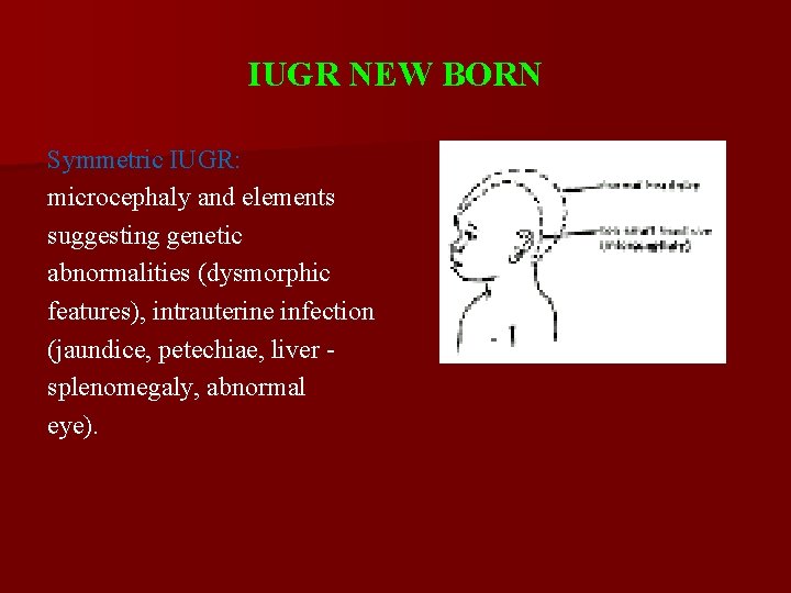 IUGR NEW BORN Symmetric IUGR: microcephaly and elements suggesting genetic abnormalities (dysmorphic features), intrauterine