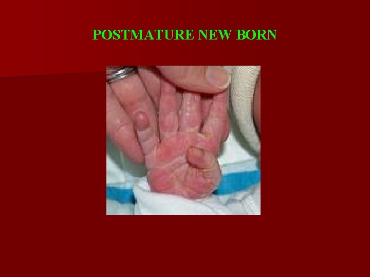 POSTMATURE NEW BORN 