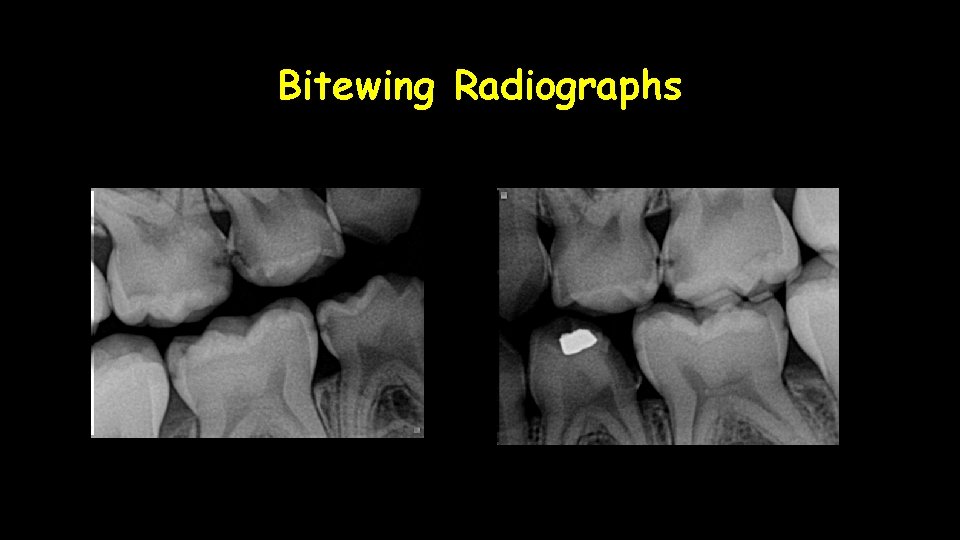 Bitewing Radiographs 