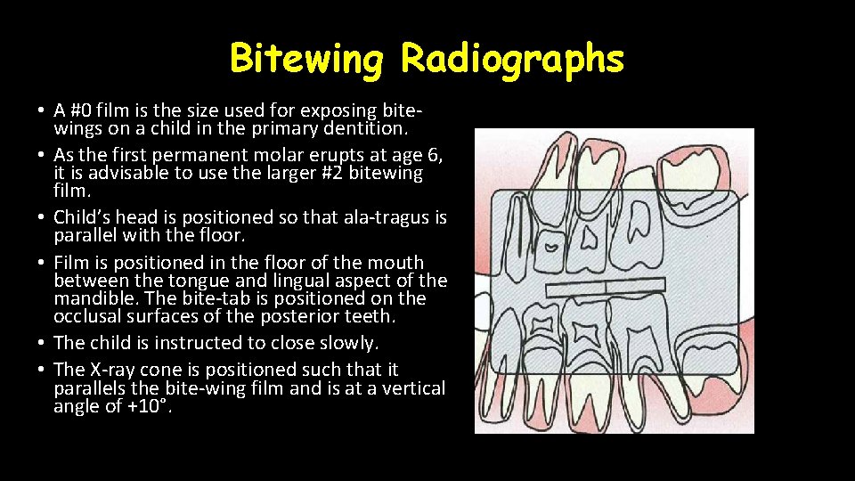 Bitewing Radiographs • A #0 film is the size used for exposing bitewings on