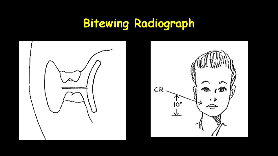 Bitewing Radiograph 