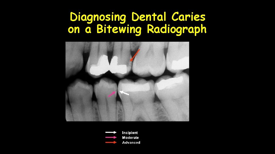 Diagnosing Dental Caries on a Bitewing Radiograph 