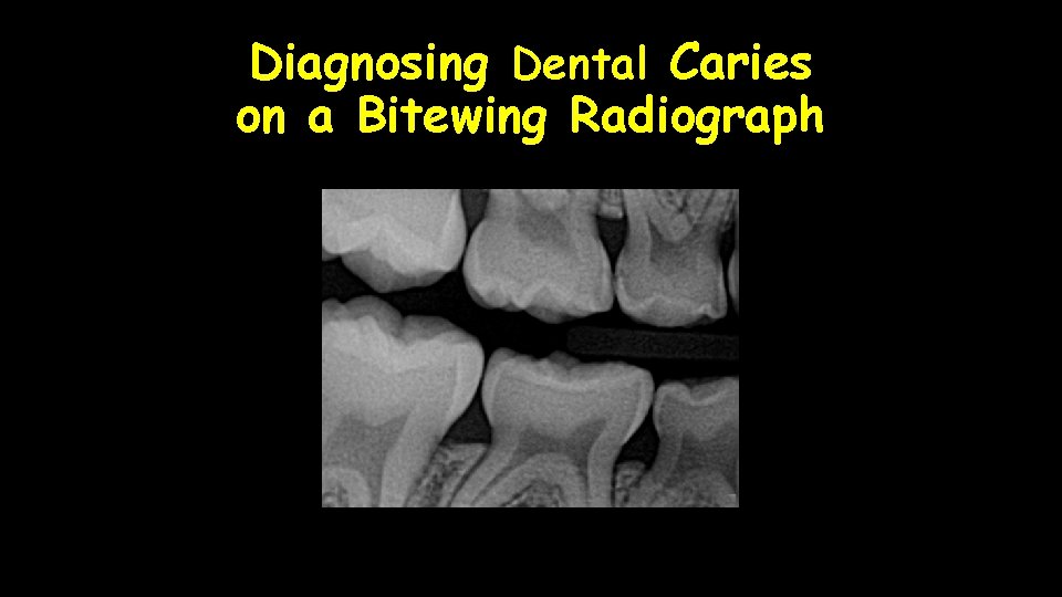 Diagnosing Dental Caries on a Bitewing Radiograph 