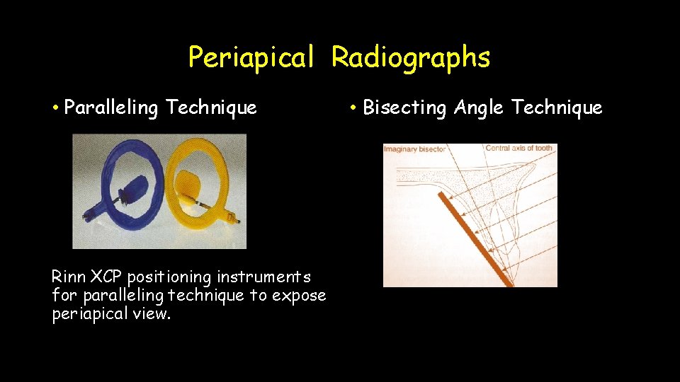 Periapical Radiographs • Paralleling Technique Rinn XCP positioning instruments for paralleling technique to expose