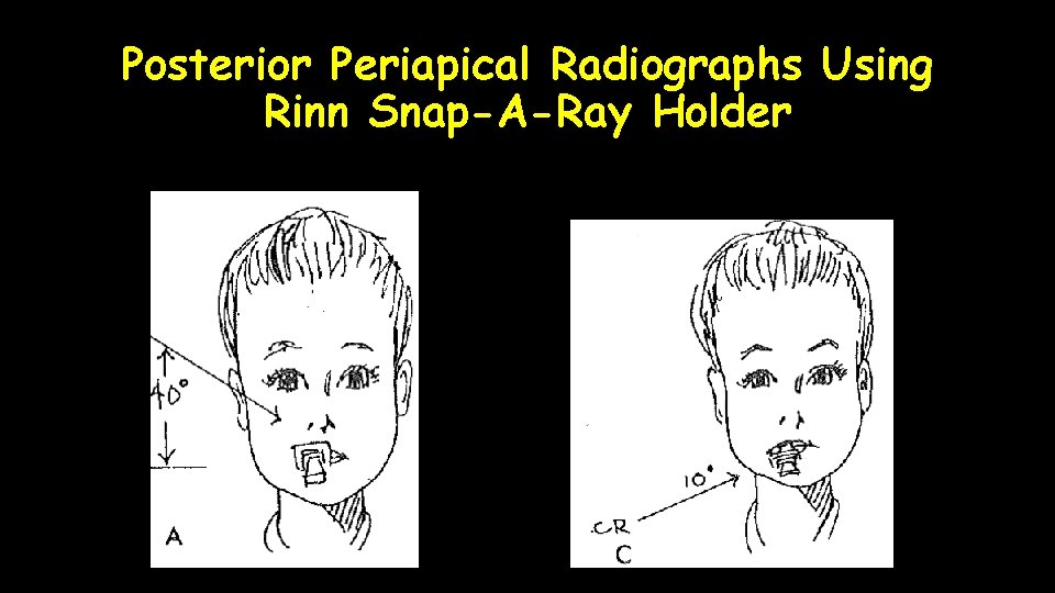 Posterior Periapical Radiographs Using Rinn Snap-A-Ray Holder 