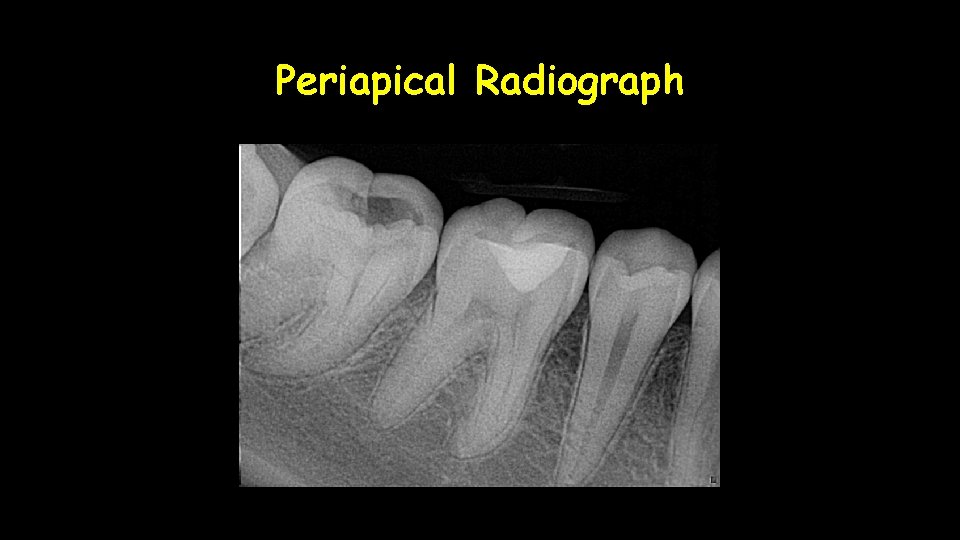Periapical Radiograph 