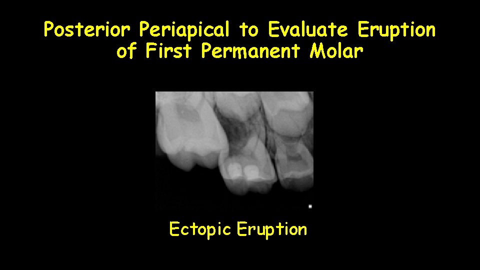 Posterior Periapical to Evaluate Eruption of First Permanent Molar Ectopic Eruption 
