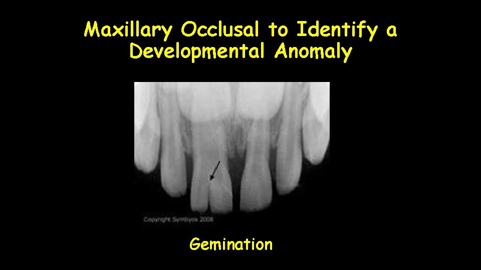 Maxillary Occlusal to Identify a Developmental Anomaly Gemination 