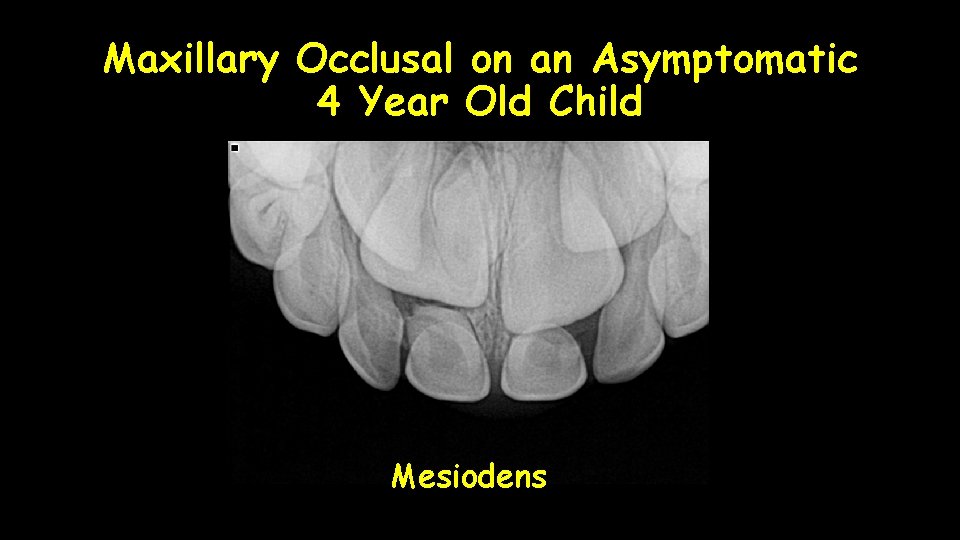 Maxillary Occlusal on an Asymptomatic 4 Year Old Child Mesiodens 