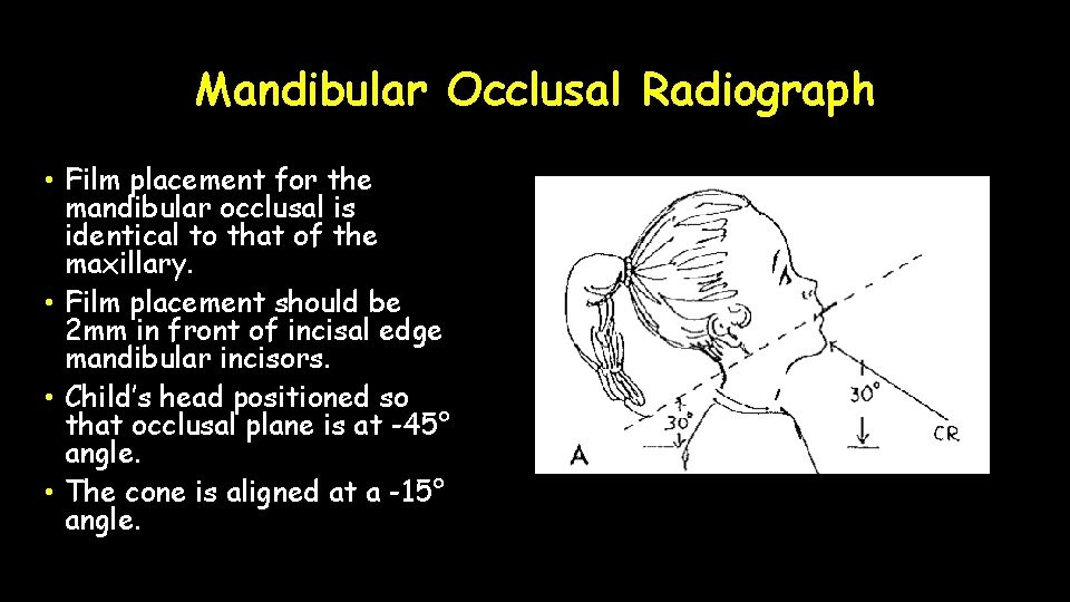 Mandibular Occlusal Radiograph • Film placement for the mandibular occlusal is identical to that