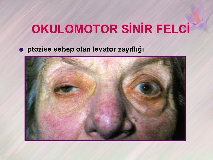 OKULOMOTOR SİNİR FELCİ ptozise sebep olan levator zayıflığı 
