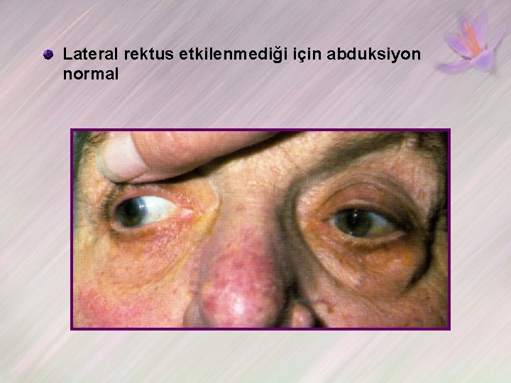Lateral rektus etkilenmediği için abduksiyon normal 