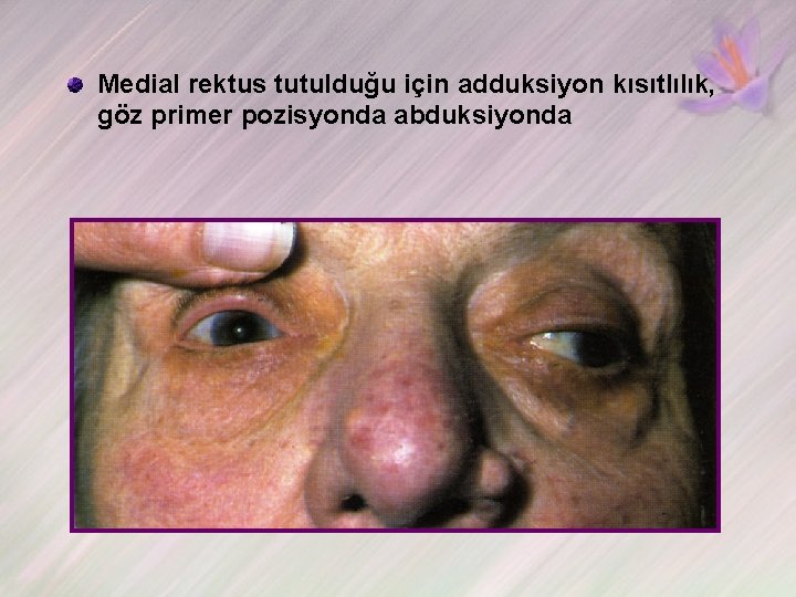 Medial rektus tutulduğu için adduksiyon kısıtlılık, göz primer pozisyonda abduksiyonda 
