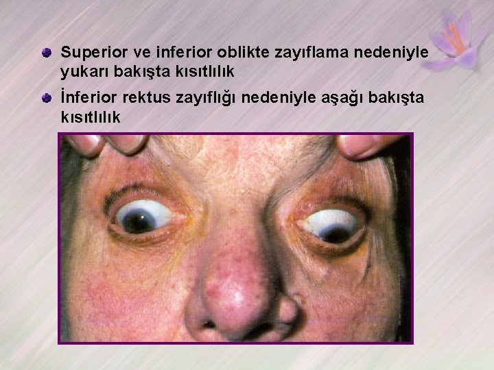 Superior ve inferior oblikte zayıflama nedeniyle yukarı bakışta kısıtlılık İnferior rektus zayıflığı nedeniyle aşağı