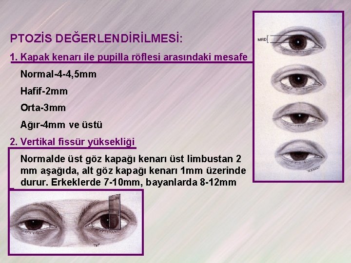 PTOZİS DEĞERLENDİRİLMESİ: 1. Kapak kenarı ile pupilla röflesi arasındaki mesafe Normal-4 -4, 5 mm