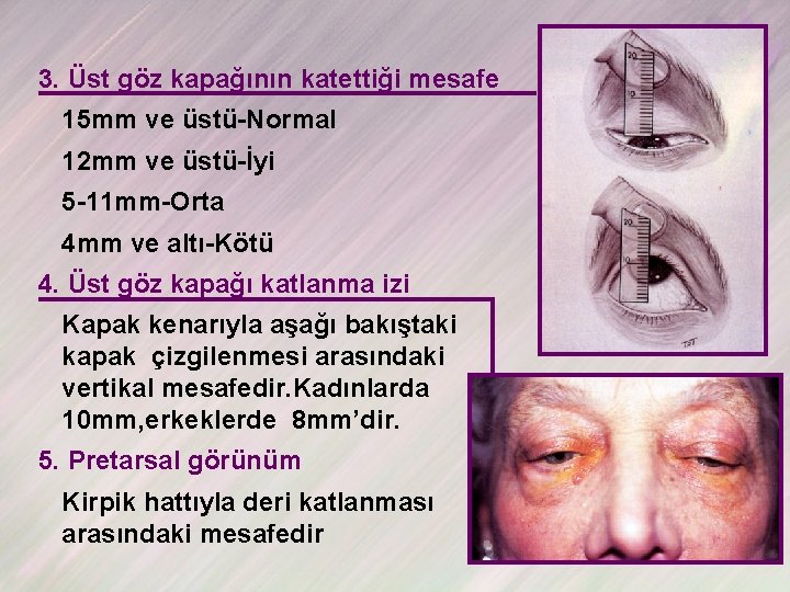 3. Üst göz kapağının katettiği mesafe 15 mm ve üstü-Normal 12 mm ve üstü-İyi