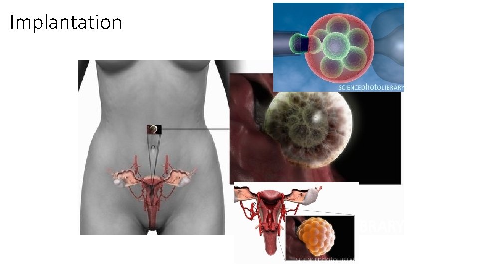 Implantation 