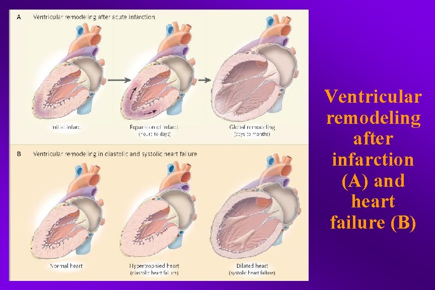 Ventricular remodeling after infarction (A) and heart failure (B) 