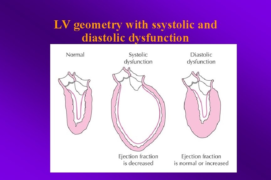 LV geometry with ssystolic and diastolic dysfunction 