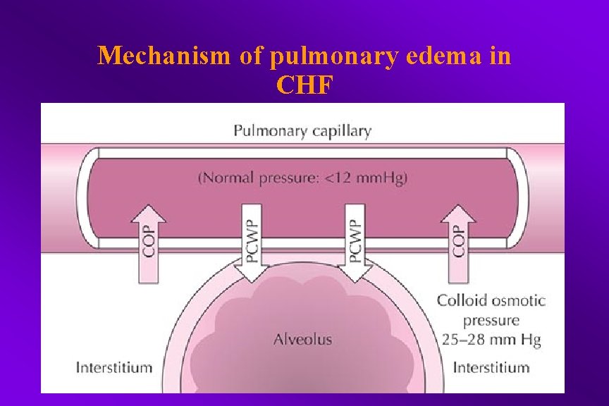Mechanism of pulmonary edema in CHF 