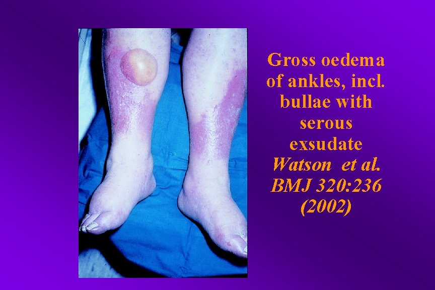 Gross oedema of ankles, incl. bullae with serous exsudate Watson et al. BMJ 320: