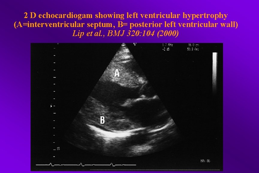 2 D echocardiogam showing left ventricular hypertrophy (A=interventricular septum, B= posterior left ventricular wall)