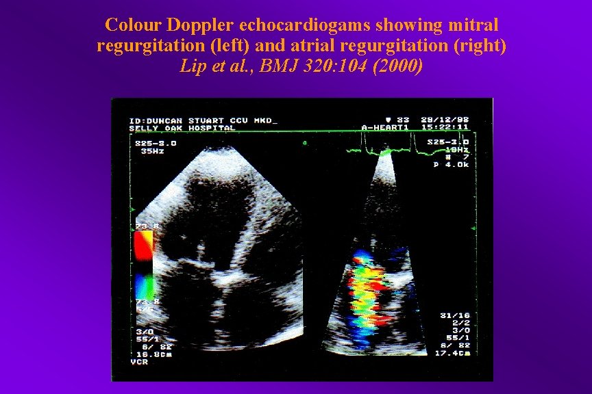 Colour Doppler echocardiogams showing mitral regurgitation (left) and atrial regurgitation (right) Lip et al.