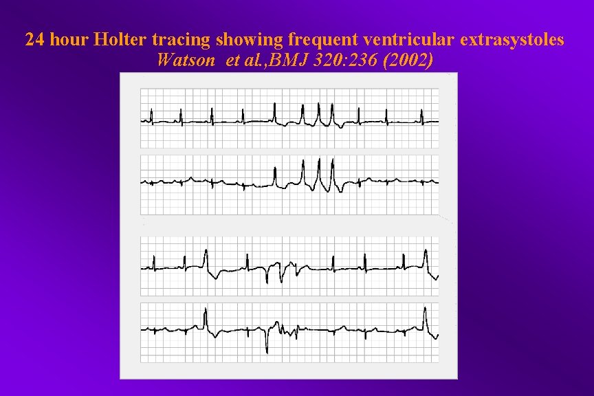 24 hour Holter tracing showing frequent ventricular extrasystoles Watson et al. , BMJ 320: