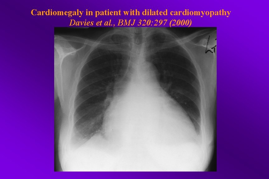 Cardiomegaly in patient with dilated cardiomyopathy Davies et al. , BMJ 320: 297 (2000)