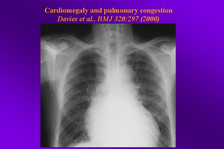 Cardiomegaly and pulmonary congestion Davies et al. , BMJ 320: 297 (2000) 