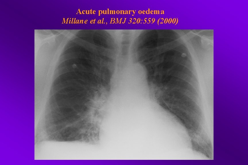 Acute pulmonary oedema Millane et al. , BMJ 320: 559 (2000) 