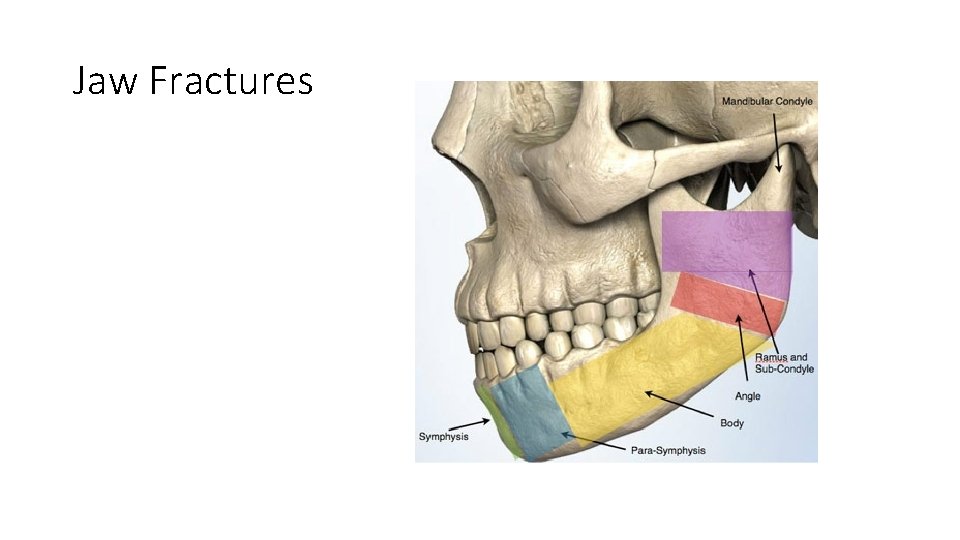 Jaw Fractures 