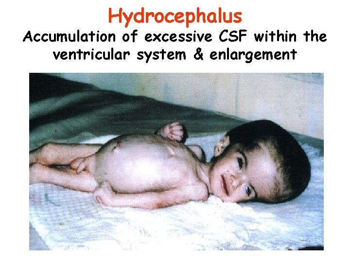 Hydrocephalus Accumulation of excessive CSF within the ventricular system & enlargement 