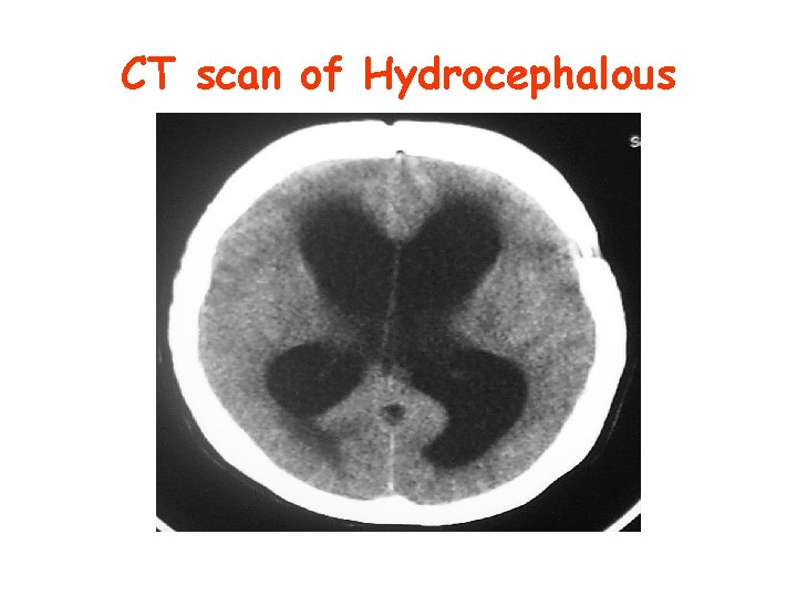 CT scan of Hydrocephalous 