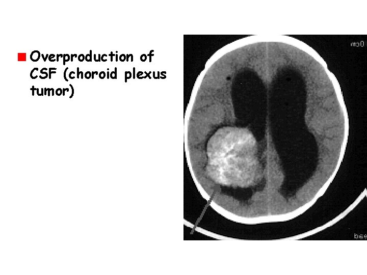 Overproduction of CSF (choroid plexus tumor) 