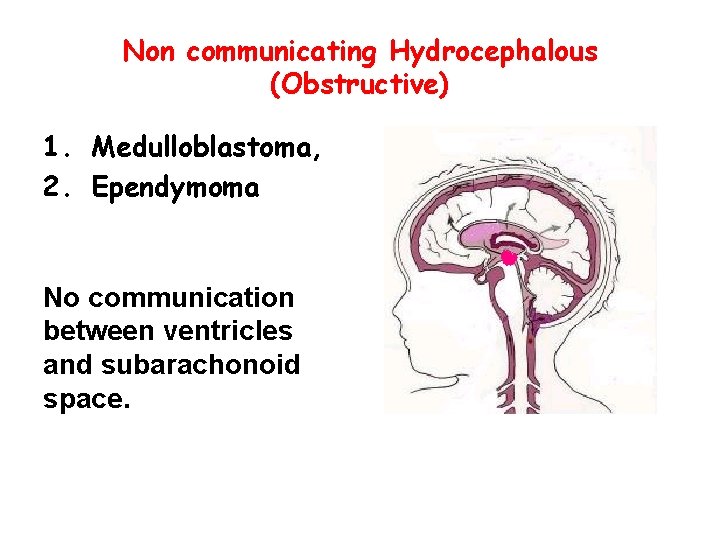 Non communicating Hydrocephalous (Obstructive) 1. Medulloblastoma, 2. Ependymoma No communication between ventricles and subarachonoid