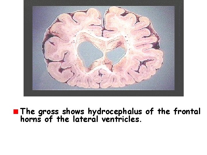 The gross shows hydrocephalus of the frontal horns of the lateral ventricles. 