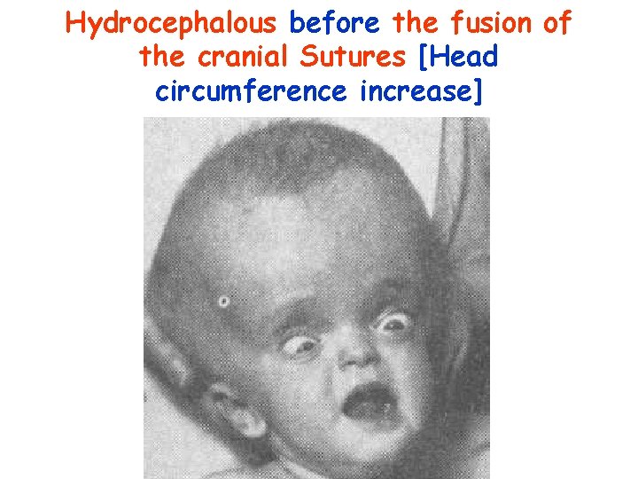 Hydrocephalous before the fusion of the cranial Sutures [Head circumference increase] 