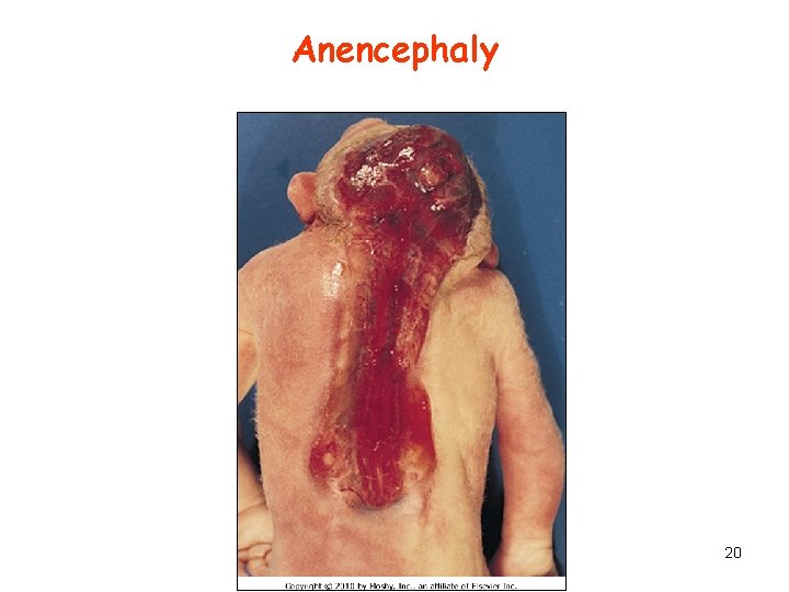 Anencephaly 20 