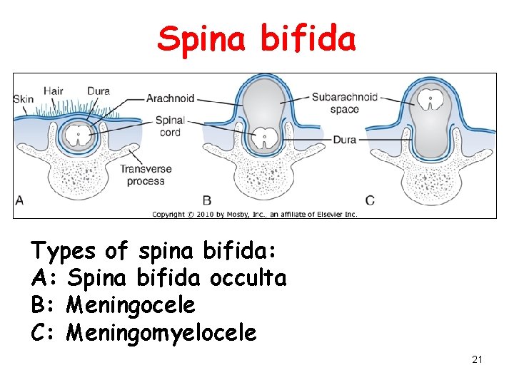 Spina bifida Types of spina bifida: A: Spina bifida occulta B: Meningocele C: Meningomyelocele